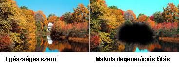 macula degeneration