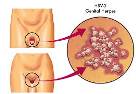 a herpes